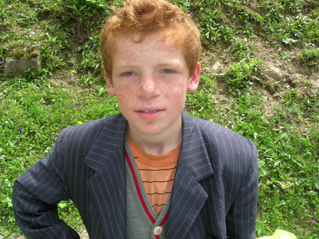 Hipospadiasız Chordee