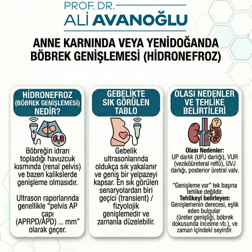 Yenidoğan hidronefroz nedir