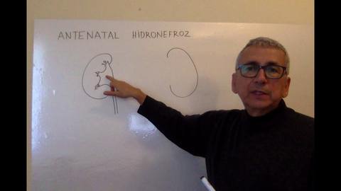 Antenatal hidronefroz